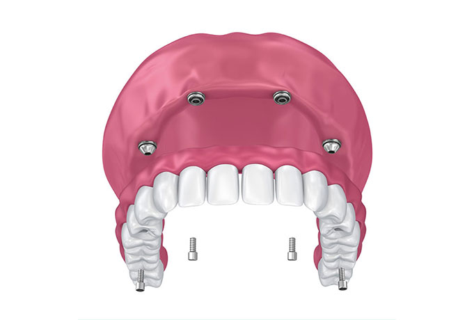 All on 4 Dental ImplantsSydney.jpg