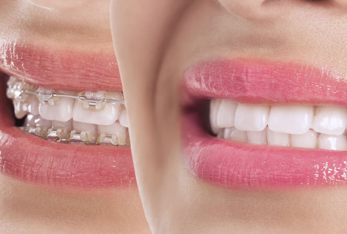 Fast Braces in Sydney and Lane Cove