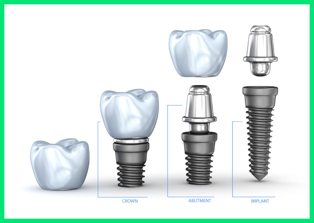 Dental Implants in Australia