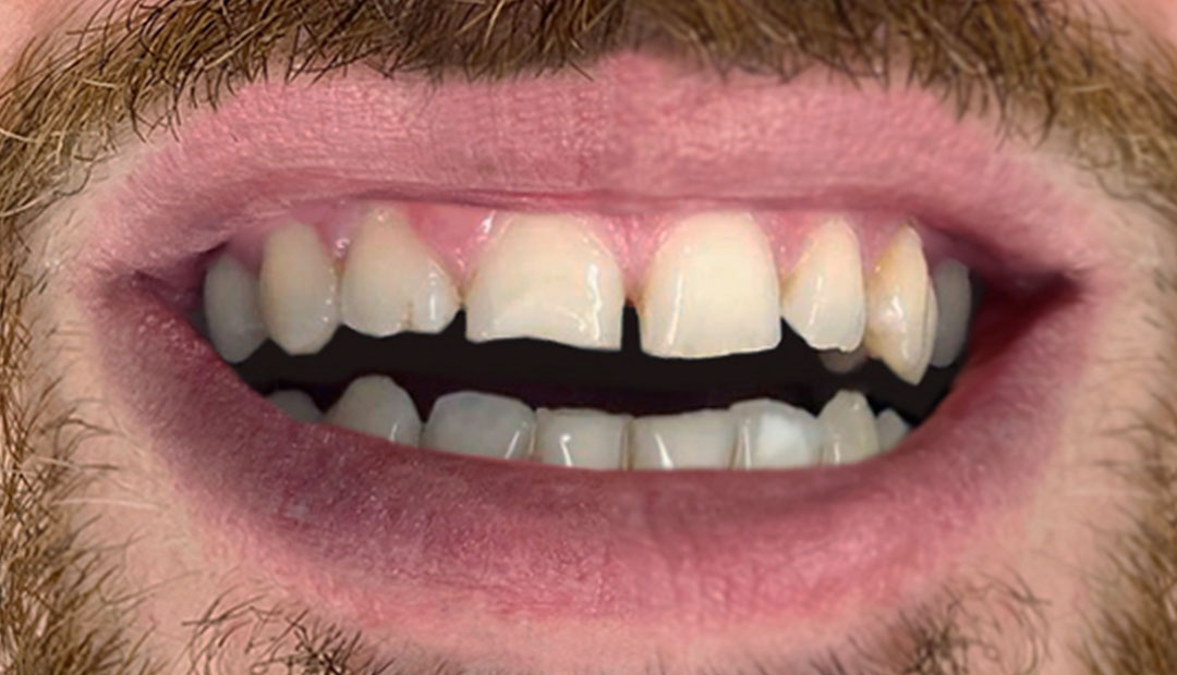 dental veneers before and after