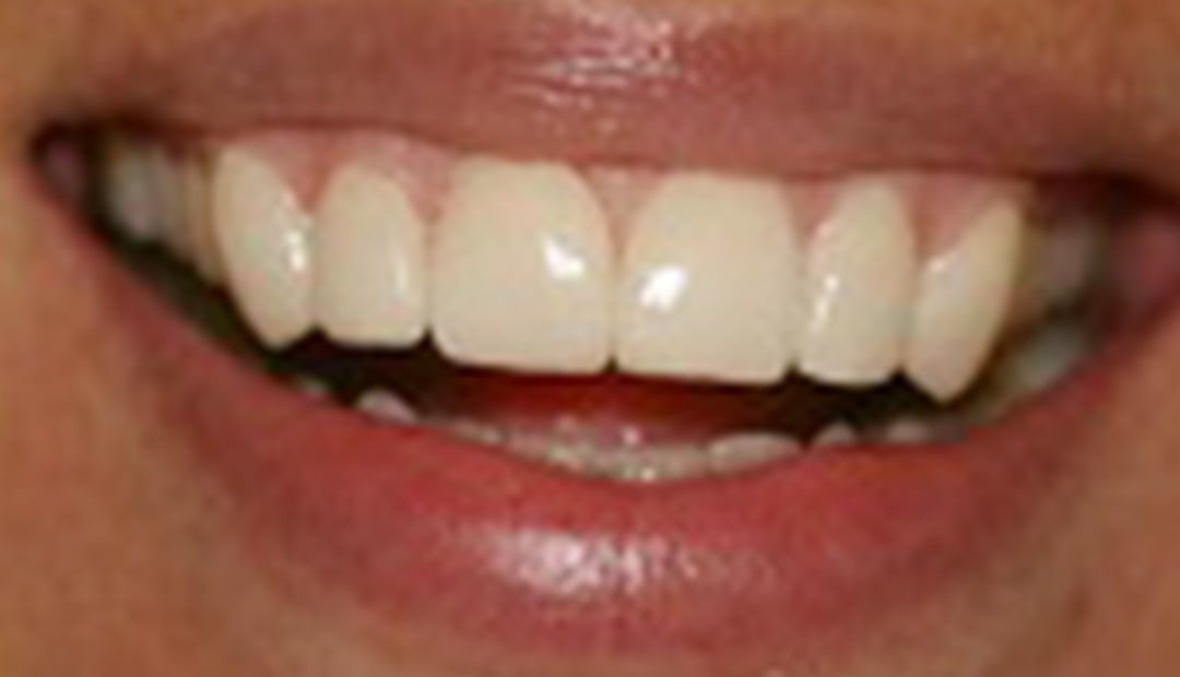 dental lumineers sydney